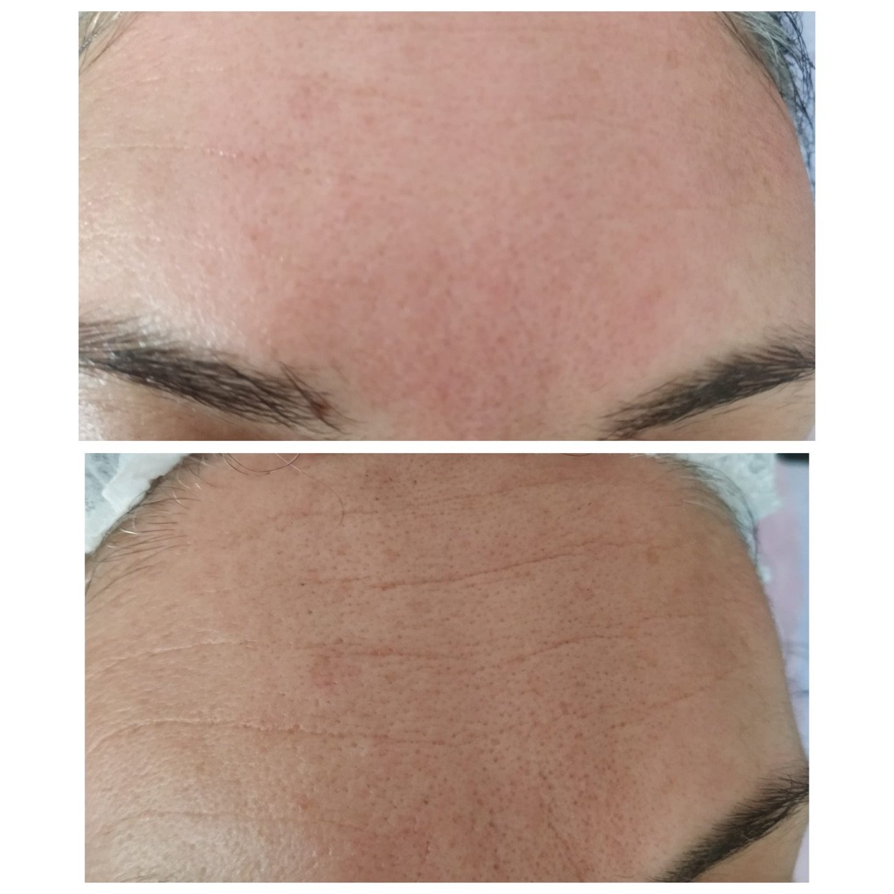 Tratamiento facial con dermapen antes y después