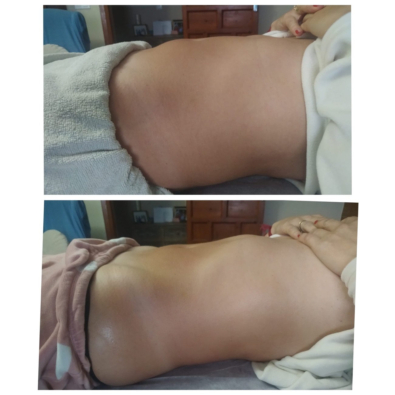 Resultado de tratamiento corporal reductor